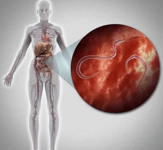 Parasiten im menschlichen Körper