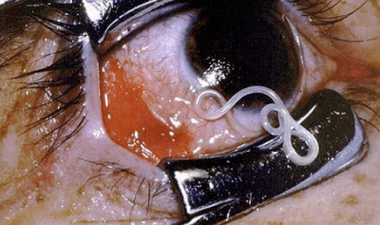 Arten von Parasiten im menschlichen Körper